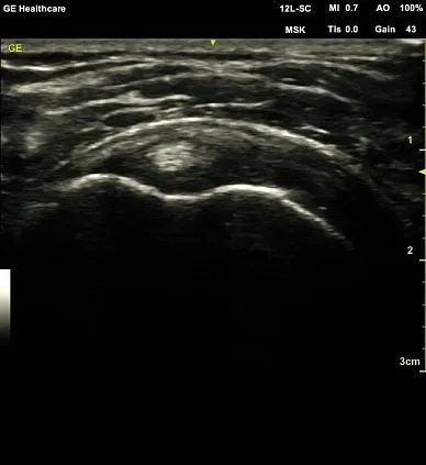 Клинические изображения GE Venue 50 аппарат УЗИ портативный