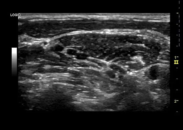 Клинические изображения GE Logiq F8 аппарат УЗИ