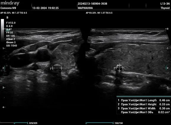 Клинические изображения УЗИ аппарат Mindray Consona N9