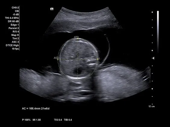 Клинические изображения Ультразвуковая система Siemens Acuson NX3 Elite