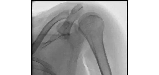 Клинические изображения С-дуга Philips Zenition 30