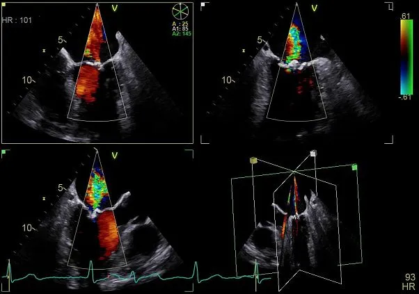 Клинические изображения GE Vivid S70 УЗИ аппарат