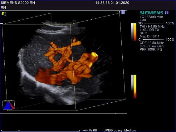 Клинические изображения Siemens ACUSON S2000 ультразвуковая система