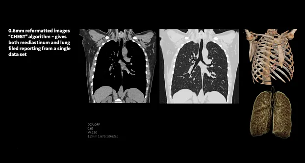 Стандартная КТ грудной клетки: спиральное сканирование всей грудной клетки