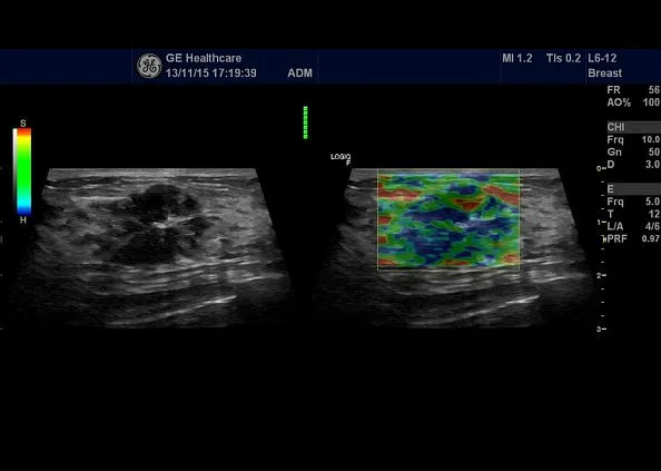 Клинические изображения GE Logiq F8 аппарат УЗИ