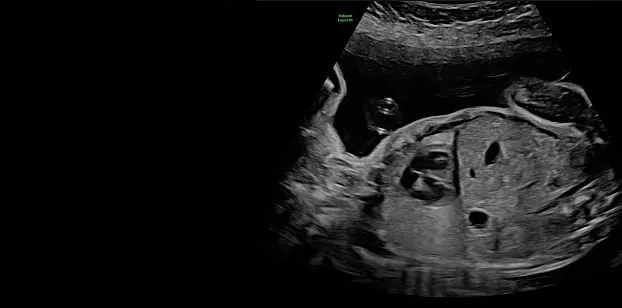 Клинические изображения УЗИ аппарат GE HealthCare Voluson Expert 22