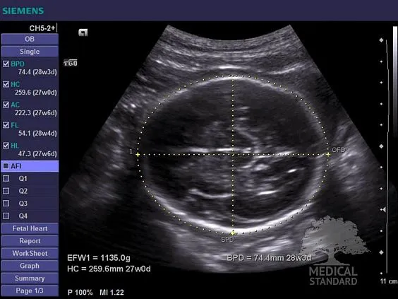 Клинические изображения Ультразвуковой аппарат Siemens Acuson X300 Premium Edition