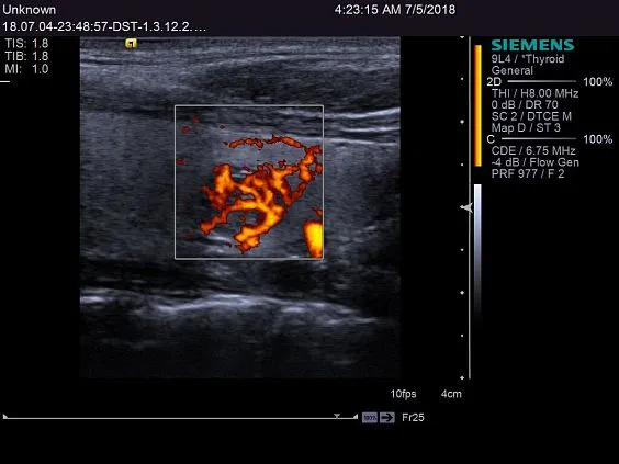 Клинические изображения Siemens ACUSON S2000 ультразвуковая система