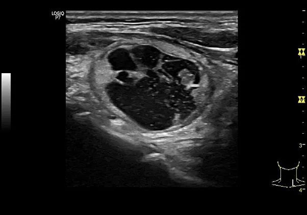 Клинические изображения Logiq P7 УЗИ аппарат GE