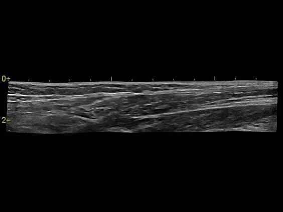 Клинические изображения Ультразвуковая диагностическая система GE HealthCare Vivid T8