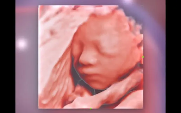 Клинические изображения УЗИ аппарат Mindray Imagyn I9