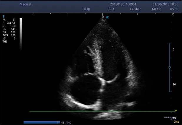 Клинические изображения Ультразвуковой аппарат Sonoscape S2N