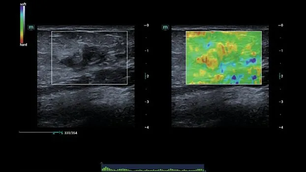 Клинические изображения УЗИ аппарат Mindray Consona N6