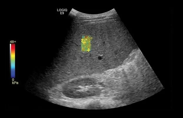 Клинические изображения УЗИ аппарат GE Healthcare Logiq E9 XDclear
