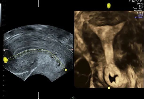 Клинические изображения УЗИ аппарат GE HealthCare Voluson S10