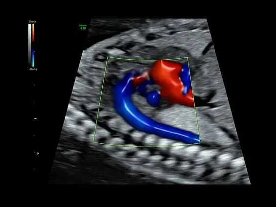 Клинические изображения Ультразвуковая диагностическая система GE Voluson E10