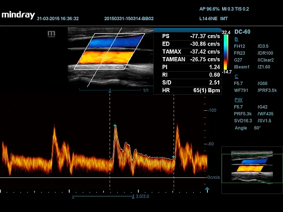 Клинические изображения УЗИ аппарат Mindray DC-60 Exp