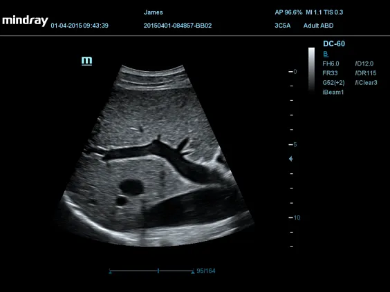 Клинические изображения УЗИ аппарат Mindray DC-55
