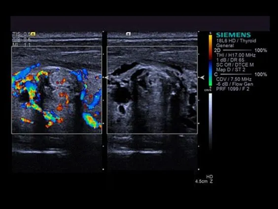 Клинические изображения Siemens Acuson S3000 ультразвуковая система