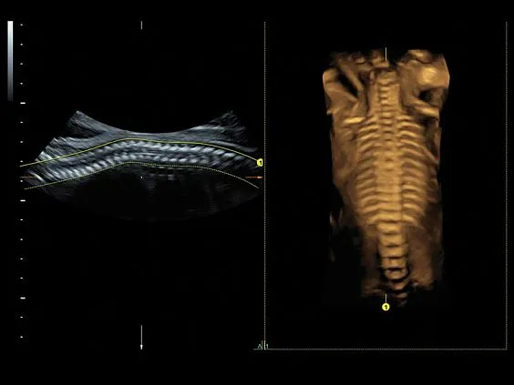 Клинические изображения GE Voluson S8 ультразвуковой аппарат