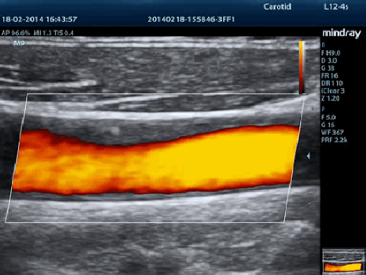 Клинические изображения УЗИ аппарат Mindray M9T портативный