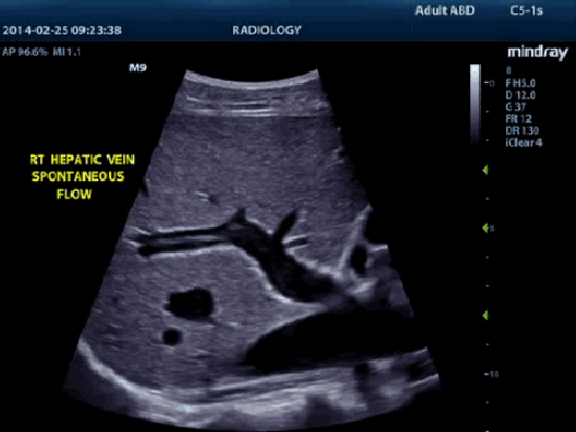 Клинические изображения УЗИ аппарат Mindray M9 портативный