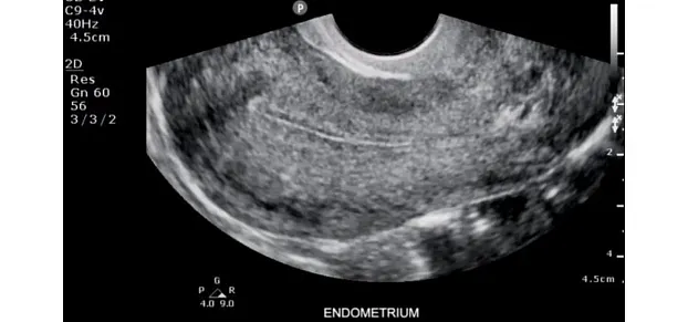 Клинические изображения Philips ClearVue 550 ультразвуковой аппарат