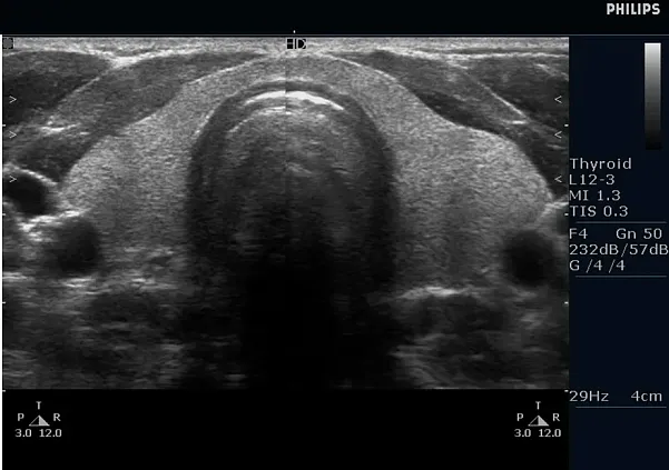 Клинические изображения Philips HD5 ультразвуковой аппарат