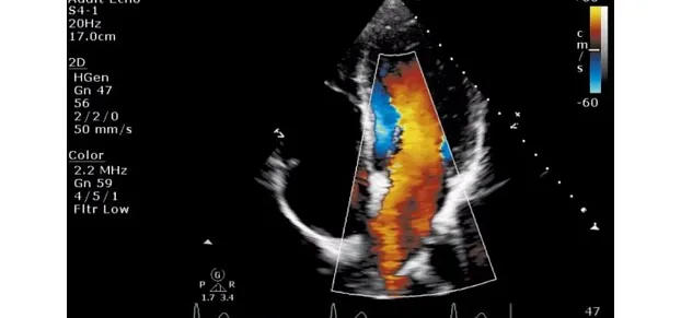 Клинические изображения Philips ClearVue 550 ультразвуковой аппарат