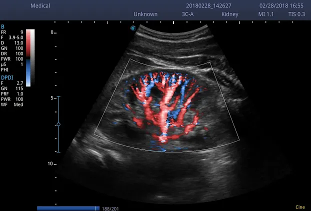 Клинические изображения Sonoscape E3 ультразвуковой аппарат