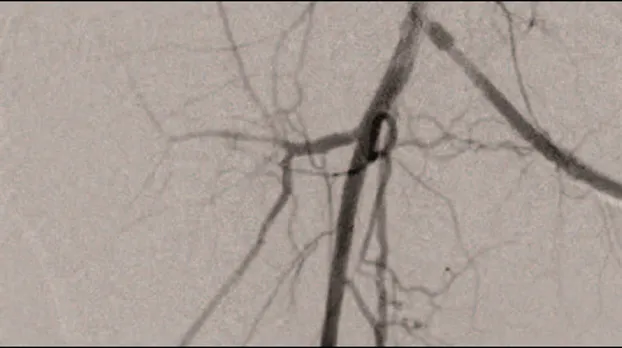 Клинические изображения Цифровой рентгеноcкопический аппарат GE Discovery RF180