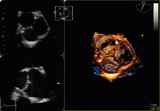 Клинические изображения Ультразвуковая диагностическая система GE HealthCare Vivid E95