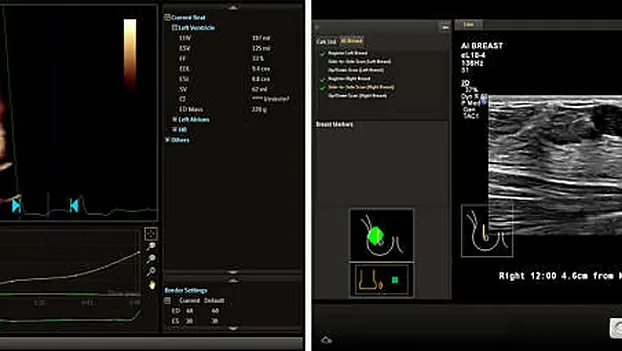 Клинические изображения Philips EPIQ Elite ультразвуковой аппарат