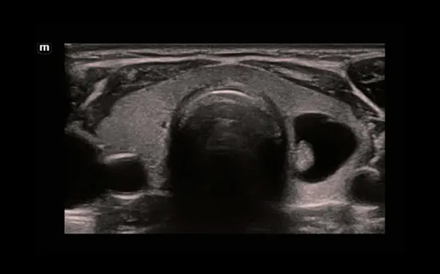 Клинические изображения УЗИ аппарат Mindray Resona i9