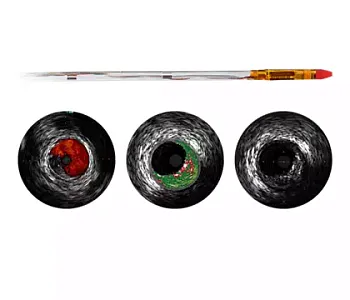 Philips Eagle Eye Platinum ST катетер ротационный