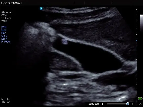 Клинические изображения Samsung Medison PT60A УЗИ аппарат