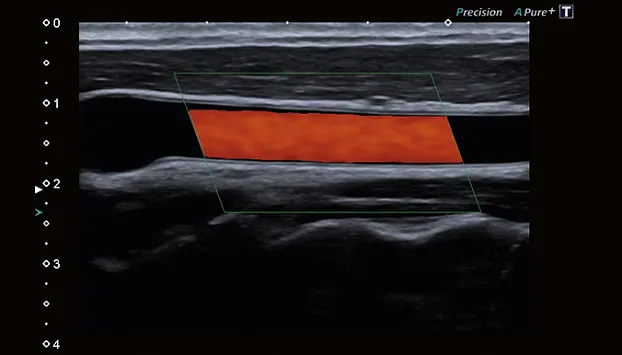 Клинические изображения Canon Xario 100G ультразвуковой аппарат