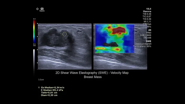 Клинические изображения Siemens Sequoia аппарат УЗИ