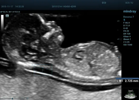 Клинические изображения УЗИ аппарат Mindray Resona 7s