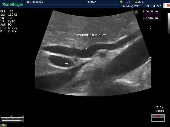 Клинические изображения Sonoscape S30 ультразвуковой аппарат