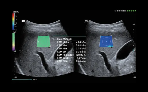 Клинические изображения УЗИ аппарат Mindray Resona i9