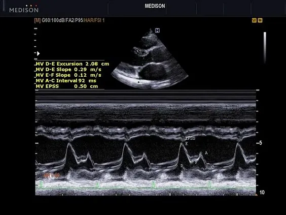 Клинические изображения Samsung Medison EKO 7 УЗИ аппарат